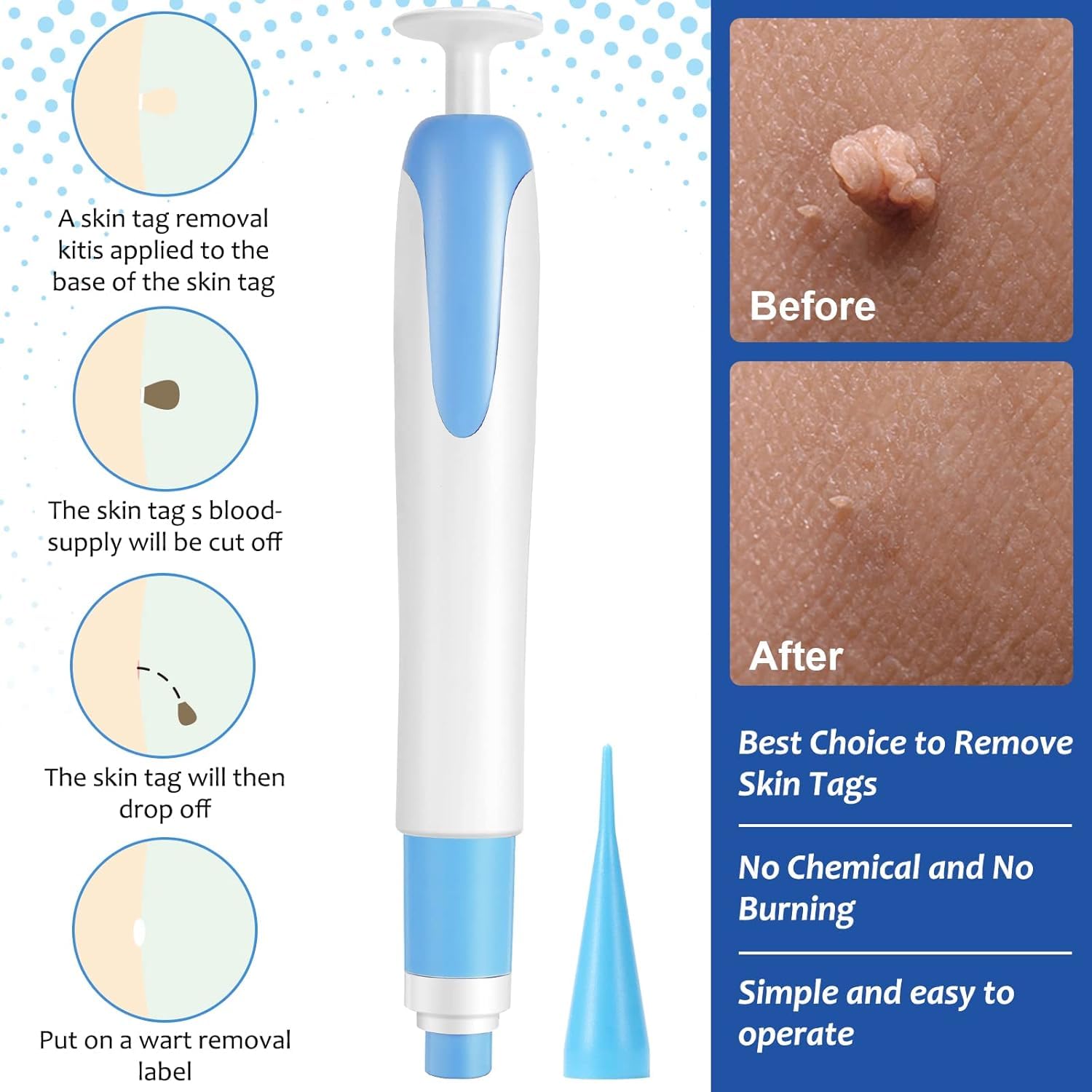 Auto Skin Tag Remover Kit for Face & Body Upgraded Fast and Easy Removal Pen with 40 Removal Bands & 10 Cleansing Wipes